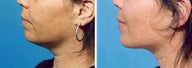 Chin Liposuction