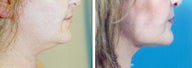 Chin Liposuction