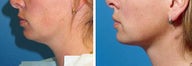 Chin Liposuction