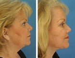 Facial plastic surgery with neck liposuction