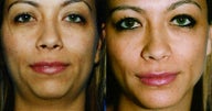 Chin Augmentation