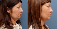 Chin Augmentation, Fat Grafting, Submental Liposuction