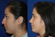 Chin Implant