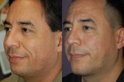 chin implant
