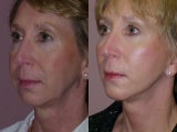 Chin Implant