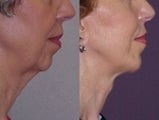 Chin Implant