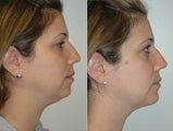 Chin Augmentation 