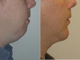 Chin Augmentation 