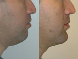 Chin Augmentation 