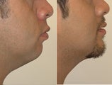 Chin Augmentation 