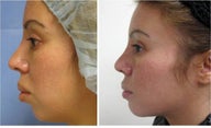 Chin Augmentation