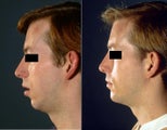 Chin Implant surgery