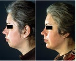 Chin Implant Surgery