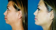 Chin Augmentation