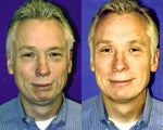 Chin implant