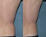 Zeltiq for fat reduction on "love handles"