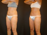 CoolSculpting
