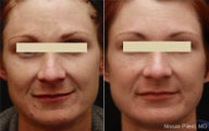 Cosmelan Advanced