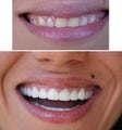 Full porcelain crowns
