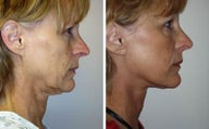 Face lift with dermabrasion front view