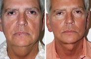 Facelift with dermabrasion