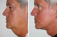 Facelift with dermabrasion