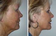 Facelift with dermabrasion