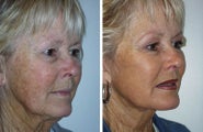 Facelift with dermabrasion