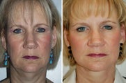 Face lift with dermabrasion 