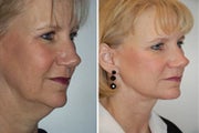 Face lift with dermabrasion 