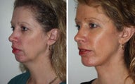 Facelift with Chin Implant, Dermabrasion