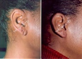 Earlobe Surgery