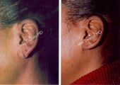 Earlobe Surgery