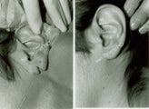 Earlobe Surgery