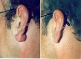 Earlobe Surgery