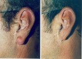 Earlobe Surgery