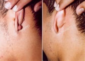 Earlobe Surgery