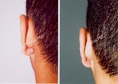 Earlobe Surgery