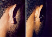 Earlobe Surgery