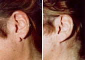 Earlobe Surgery