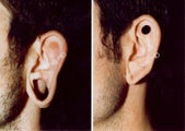 Earlobe Surgery