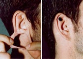 Ear Lobe Surgery