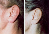 Earlobe Surgery