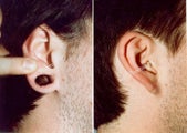 Earlobe Surgery