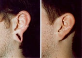 Earlobe Surgery