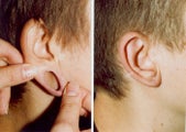 Earlobe Surgery