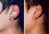 Earlobe Surgery