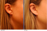 Earlobe Repair