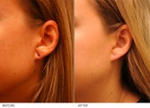 Earlobe Repair- left