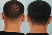 Otoplasty